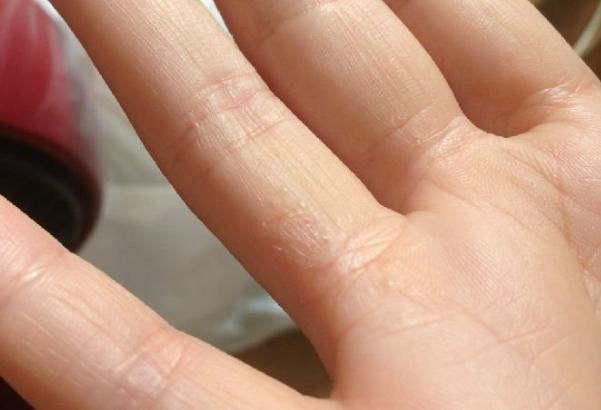 為什么會得水皰型手癬 水皰型手癬怎么根治 為什么會得水皰型手癬 水皰型手癬怎么根治