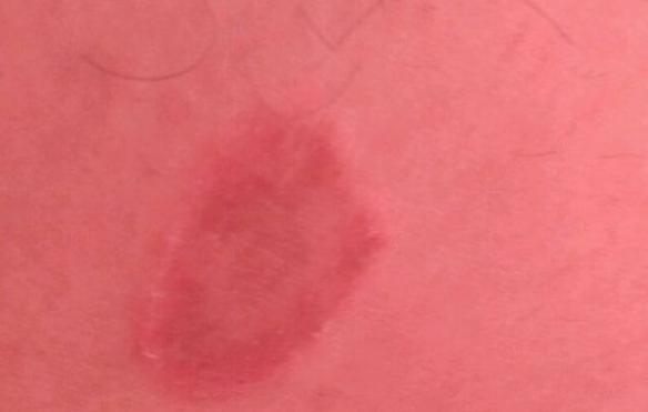 體癬的并發(fā)癥有什么 體癬是什么樣子的 體癬的并發(fā)癥有什么 體癬是什么樣子的