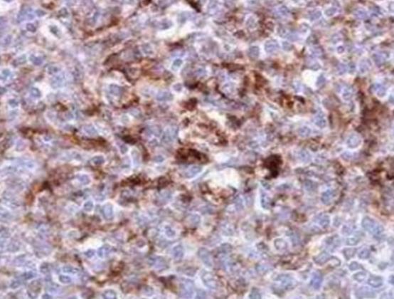 世界十大治不愈的病,慢性疲勞綜合癥、自身免疫失調(diào)都是慢性難治療 世界十大治不愈的病,慢性疲勞綜合癥、自身免疫失調(diào)都是慢性難治療