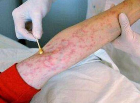 世界十大治不愈的病,慢性疲勞綜合癥、自身免疫失調(diào)都是慢性難治療 世界十大治不愈的病,慢性疲勞綜合癥、自身免疫失調(diào)都是慢性難治療