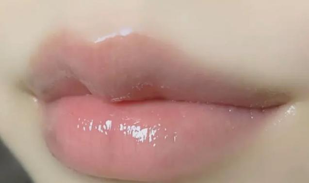 嘴唇周圍發黑怎么回事 唇周黑色素怎么去除 嘴唇周圍發黑怎么回事 唇周黑色素怎么去除