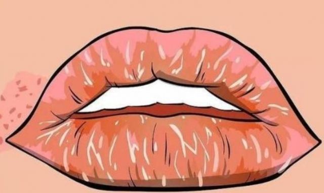 嘴唇周圍發黑怎么回事 唇周黑色素怎么去除 嘴唇周圍發黑怎么回事 唇周黑色素怎么去除