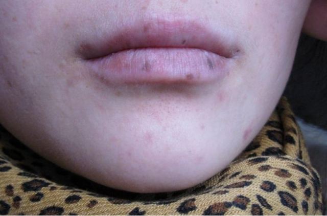 嘴唇干裂蛻皮怎么辦 嘴唇干裂脫皮涂什么好 嘴唇干裂蛻皮怎么辦 嘴唇干裂脫皮涂什么好