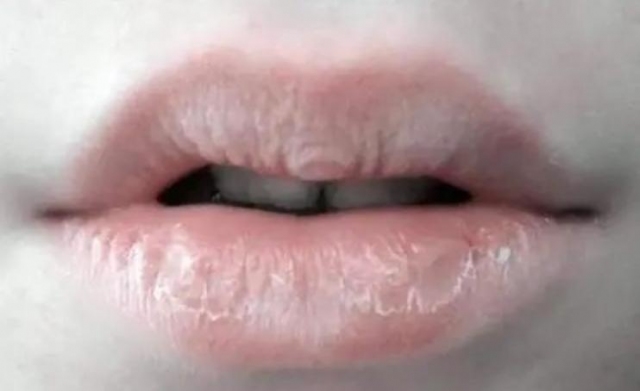 嘴唇干裂脫皮缺什么維生素 嘴唇干裂是缺乏維生素c嗎 嘴唇干裂脫皮缺什么維生素 嘴唇干裂是缺乏維生素c嗎