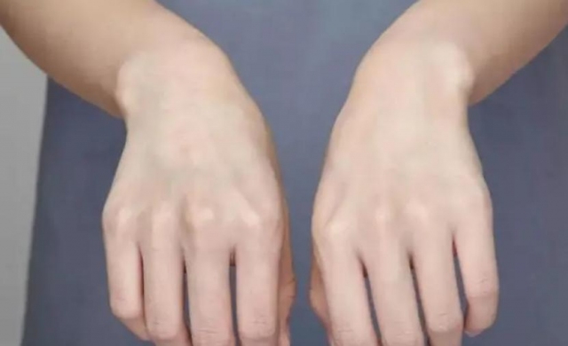 Ů�����Ӿ�˥��ԓ����ʳ ���O��15��Ƥ�w�������������Æ�