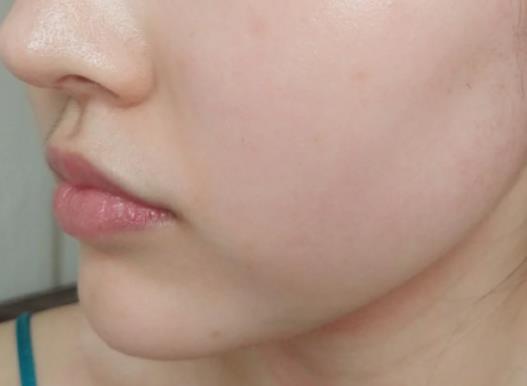 服用阿維A真的要兩年以后才能要孩子嗎?吃異維a酸軟膠囊會(huì)胎停嗎 服用阿維A真的要兩年以后才能要孩子嗎?吃異維a酸軟膠囊會(huì)胎停嗎