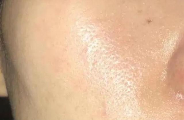 臉上一直出油怎么辦 臉上冒痘跟出油有關(guān)系嗎 臉上一直出油怎么辦 臉上冒痘跟出油有關(guān)系嗎