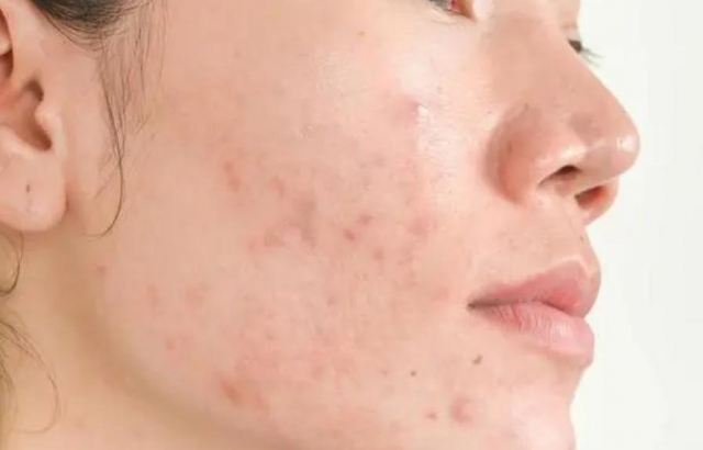 頭發(fā)和臉愛出油是什么原因 臉愛出油如何調(diào)整 頭發(fā)和臉愛出油是什么原因 臉愛出油如何調(diào)整