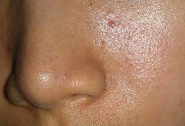 男生臉上出油厲害怎么辦 男生臉上出油的常見原因 男生臉上出油厲害怎么辦 男生臉上出油的常見原因