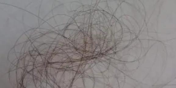 頭頂莫名其妙的禿了兩塊是怎么回事兒 為什么頭發會禿一塊 頭頂莫名其妙的禿了兩塊是怎么回事兒 為什么頭發會禿一塊