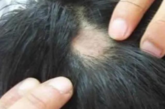 頭頂莫名其妙的禿了兩塊是怎么回事兒 為什么頭發會禿一塊 頭頂莫名其妙的禿了兩塊是怎么回事兒 為什么頭發會禿一塊