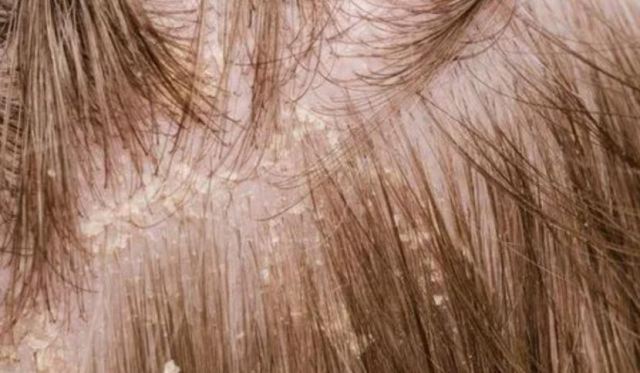 脫發吃維生素B2還是B6 掉頭發看皮膚科嗎 脫發吃維生素B2還是B6 掉頭發看皮膚科嗎