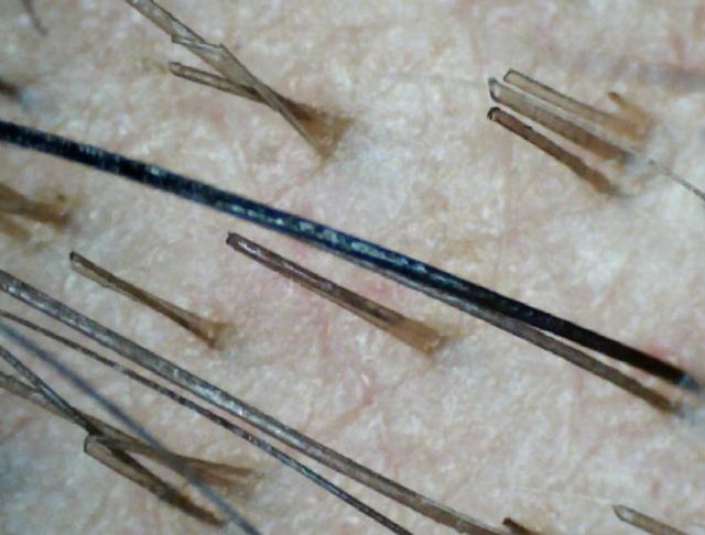 毛囊損傷是什么癥狀 毛囊損傷可以恢復嗎 毛囊損傷是什么癥狀 毛囊損傷可以恢復嗎