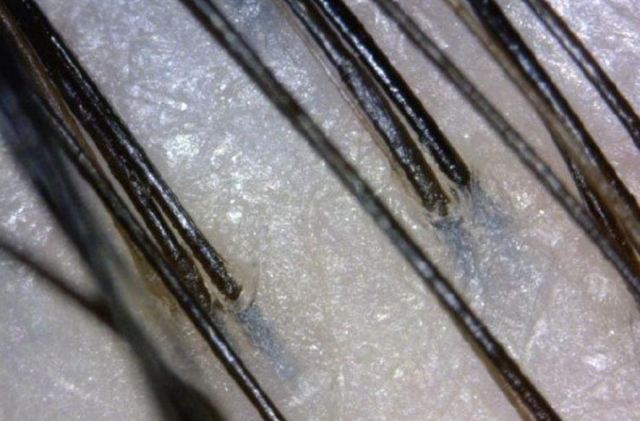 頭發(fā)毛囊多久會(huì)壞死 如何修復(fù)頭發(fā)毛囊受損 頭發(fā)毛囊多久會(huì)壞死 如何修復(fù)頭發(fā)毛囊受損