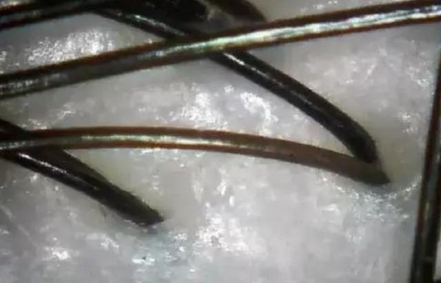 頭發(fā)毛囊壞死還有救嗎 頭發(fā)毛囊可以再生嗎 頭發(fā)毛囊壞死還有救嗎 頭發(fā)毛囊可以再生嗎