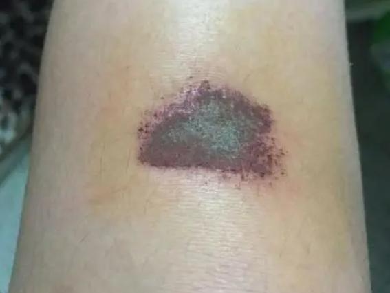 ���ڽY�����滯ē���������ܺ� �Y�軯ēҪ��Ҫȥ����Ƥ