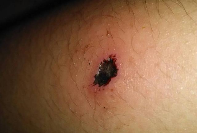 ���ڽY�����滯ē���������ܺ� �Y�軯ēҪ��Ҫȥ����Ƥ