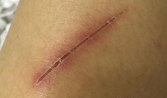 ���ڽY�����滯ē���������ܺ� �Y�軯ēҪ��Ҫȥ����Ƥ