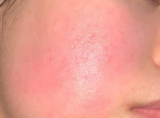 角質層薄怎么修復增厚 角質層太薄會自己增厚嗎 角質層薄怎么修復增厚 角質層太薄會自己增厚嗎