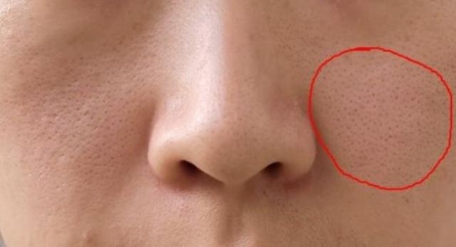 用a醇皮膚毛孔為什么會變大 泥膜可以收縮毛孔嗎 用a醇皮膚毛孔為什么會變大 泥膜可以收縮毛孔嗎