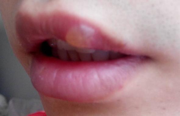 吃荔枝不上火怎么做 上火嘴唇起泡怎么辦 吃荔枝不上火怎么做 上火嘴唇起泡怎么辦