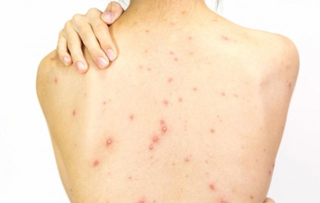 臉上長(zhǎng)痘很正常 后背為什么會(huì)長(zhǎng)痘 臉上長(zhǎng)痘很正常 后背為什么會(huì)長(zhǎng)痘