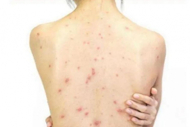 祛除后背痘痘的方法 這些方法很適合 祛除后背痘痘的方法 這些方法很適合