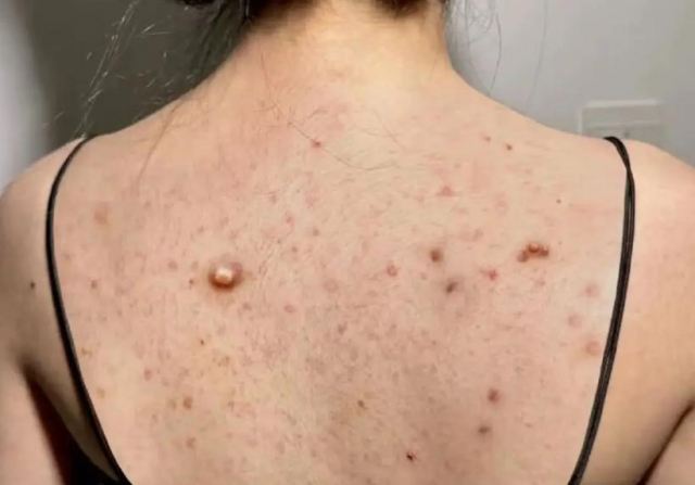 祛除后背痘痘的方法 這些方法很適合 祛除后背痘痘的方法 這些方法很適合