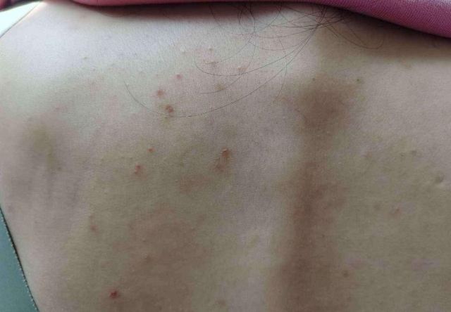 后背長痘痘注意避免這些情況 汗水導致細菌生長 后背長痘痘注意避免這些情況 汗水導致細菌生長