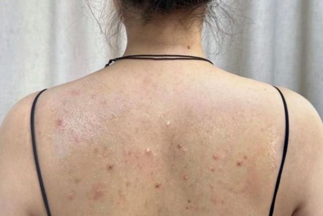 背部有痘痘的原因 對(duì)癥解決效果好 背部有痘痘的原因 對(duì)癥解決效果好