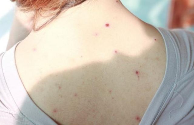 后背長痘痘的一些防治方法推薦 后背長痘痘用硫磺皂有用嗎 后背長痘痘的一些防治方法推薦 后背長痘痘用硫磺皂有用嗎