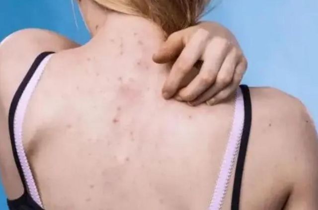 后背長痘痘的一些防治方法推薦 后背長痘痘用硫磺皂有用嗎 后背長痘痘的一些防治方法推薦 后背長痘痘用硫磺皂有用嗎