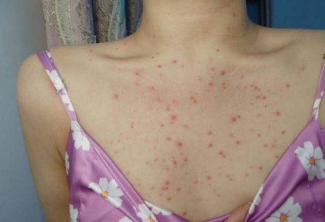 青春期的煩惱 胸背長痘痘 青春期的煩惱 胸背長痘痘