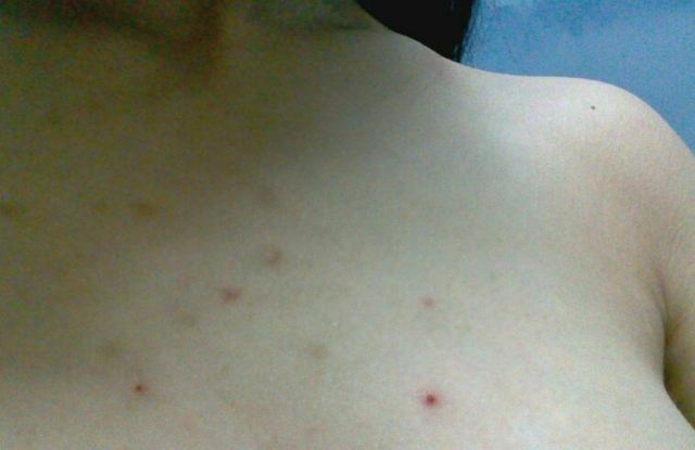 青春期的煩惱 胸背長痘痘 青春期的煩惱 胸背長痘痘