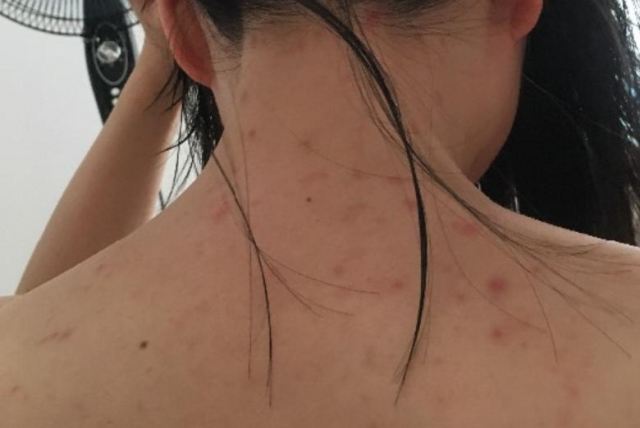 背上長痘怎么辦好 后背的痘痘不管什么辦法都消不掉怎么回事 背上長痘怎么辦好 后背的痘痘不管什么辦法都消不掉怎么回事