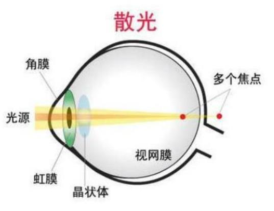 散光近視眼能恢復嗎?近視眼都有散光嗎 散光近視眼能恢復嗎?近視眼都有散光嗎