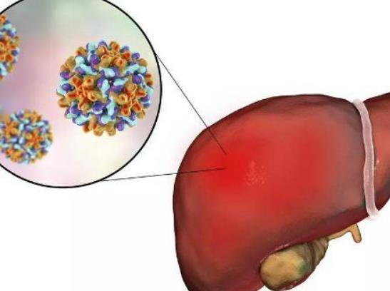 酒精肝好治嗎?酒精肝高發(fā)人群有哪些 酒精肝好治嗎?酒精肝高發(fā)人群有哪些