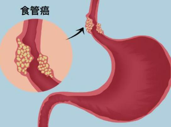 胃食道逆流還是食道癌病兆?食道癌的4個早期癥狀表現 胃食道逆流還是食道癌病兆?食道癌的4個早期癥狀表現