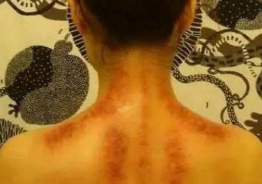 可以用硬幣刮痧嗎?刮痧后有淤青是怎么回事 可以用硬幣刮痧嗎?刮痧后有淤青是怎么回事