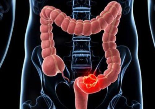 潰瘍性結腸炎吃什么好?急性結腸炎多久能好 潰瘍性結腸炎吃什么好?急性結腸炎多久能好