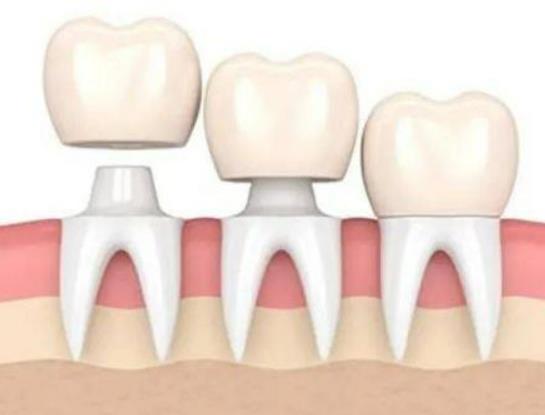 種植一顆牙齒多少錢?種植義齒修復要多久 種植一顆牙齒多少錢?種植義齒修復要多久