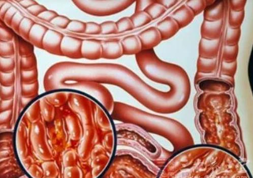 慢性結腸炎嚴重嗎?結腸炎會引起口臭嗎 慢性結腸炎嚴重嗎?結腸炎會引起口臭嗎